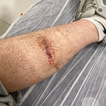 Martı Scooter’da Yaşadığım Şiddetli Kaza Sonucu İş Gücümün Kaybı Ve Tazminat Talebi