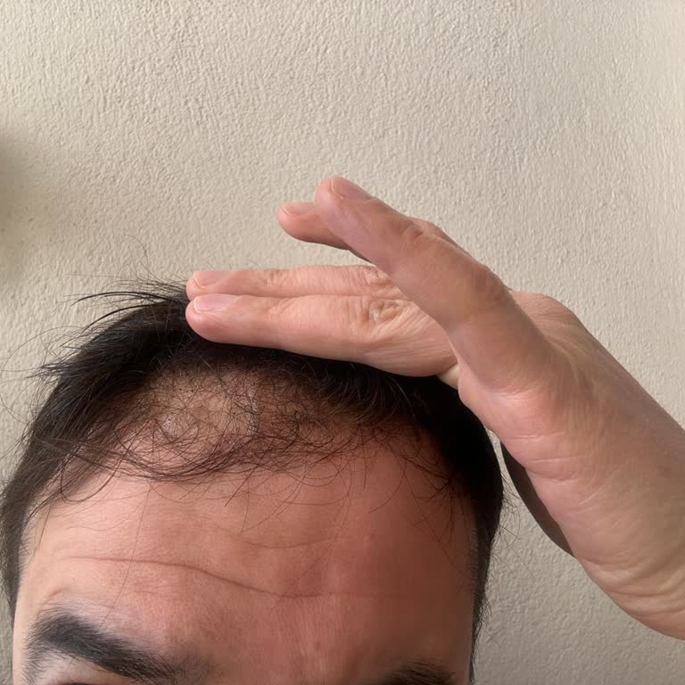 Soft Hair Protez Saç Merkezi Bilinçsiz, Acemi İşlem Sonucu Belirgin Şekilde Deformasyon Ve Saç Kaybı
