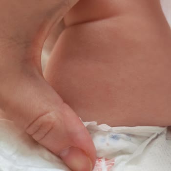 Качество подгузников Huggies Elite Soft Не соответсвует Заявленному, раздражение кожи и сыпь