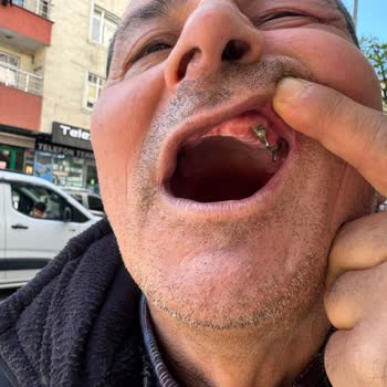 Cerrahi Grup Diş Sağlığı Ömür Boyu Garantili İmplant Kırıldı; Hastanede Şiddetle Karşılaştım