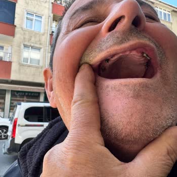 Cerrahi Grup Diş Sağlığı Ömür Boyu Garantili İmplant Kırıldı; Hastanede Şiddetle Karşılaştım