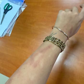 Lazer İşlemi Sonrası Kol Yanığı Ve Kalıcı İzler: Yetersiz İade Ve Tatmin Edici Olmayan İletişim