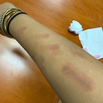 Lazer İşlemi Sonrası Kol Yanığı Ve Kalıcı İzler: Yetersiz İade Ve Tatmin Edici Olmayan İletişim