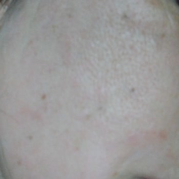 Lure Sir Ağdayı Kullanım Sonrası Şiddetli Kızarıklık, Sivilcelenme Ve Yanma