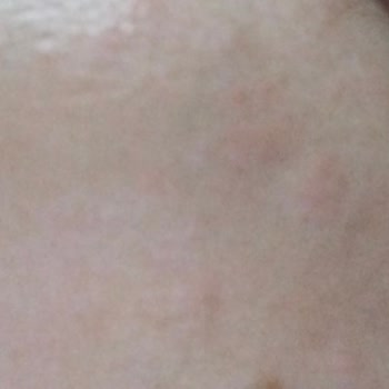 Lure Sir Ağdayı Kullanım Sonrası Şiddetli Kızarıklık, Sivilcelenme Ve Yanma