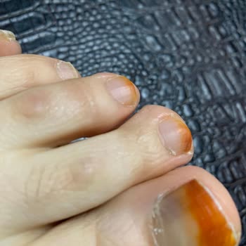 Sağlığıma Zarar Veren Nike Initiator Ayakkabı İçin Ücret İadesi Talebi
