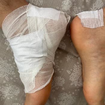 Derimod Botunda Üretim Hatası Ve Topuk Yarası Şikayetimiz