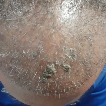 Clinicana Hair Transplant Malpractice And Excess Graft Loss