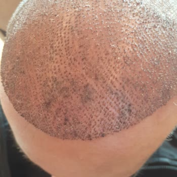 Clinicana Hair Transplant Malpractice And Excess Graft Loss