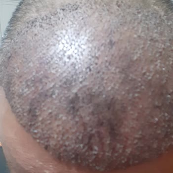 Clinicana Hair Transplant Malpractice And Excess Graft Loss