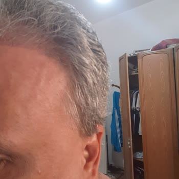 Clinicana Hair Transplant Malpractice And Excess Graft Loss