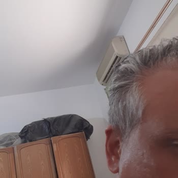 Clinicana Hair Transplant Malpractice And Excess Graft Loss