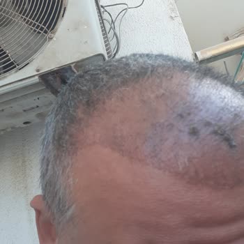 Clinicana Hair Transplant Malpractice And Excess Graft Loss
