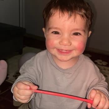Bebekte Şampuan Kullanımının Ardından Şiddetli Kızarıklık Ve Kaşıntı