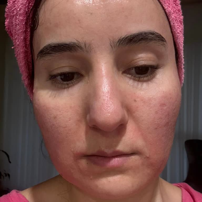 Ciltte Alerjik Reaksiyon Ve Ürün İadesi Talebi