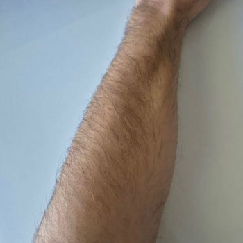 Yanıltıcı Reklam Ve Etkin Olmayan Lazer Epilasyon Sonuçları Nedeniyle Ücret İadesi Talebi