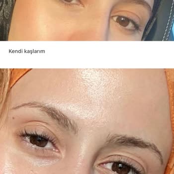 Kaş Laminasyonunda Yanma Ve Uzun Süreli Hasar