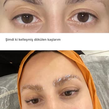 Kaş Laminasyonunda Yanma Ve Uzun Süreli Hasar