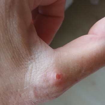 Tetikli Dyson Süpürge El Tahrişi ve Sağlık Sorunu, Tetiksiz Değişim Talebi
