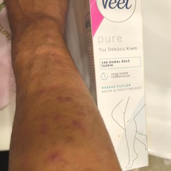Veet Pure Tüy Dökücü Kremde Şiddetli Cilt Tahrişi Ve Sağlık Mağduriyeti