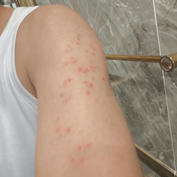 Veet Pure Tüy Dökücü Kremde Şiddetli Cilt Tahrişi Ve Sağlık Mağduriyeti
