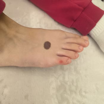 Deichmann Çocuk Ayakkabısının Ayak Yarası Nedeniyle Ücret İadesi Talebi