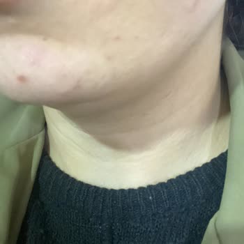 Alerjik Reaksiyon Ve Sivilcelenme Sonrası Kaba Müşteri Hizmetleri İade Talebi