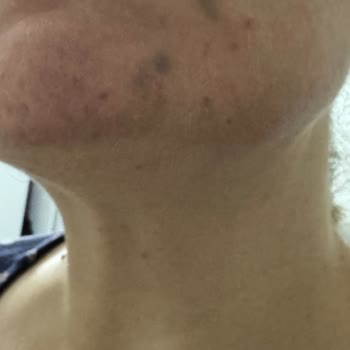 Yüz Lazer İşleminde Ağrı Durdurulmadı, Yanık Ve Morluk İzleri Bıraktı