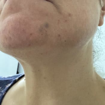 Yüz Lazer İşleminde Ağrı Durdurulmadı, Yanık Ve Morluk İzleri Bıraktı