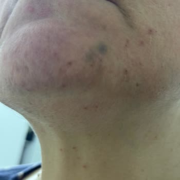 Yüz Lazer İşleminde Ağrı Durdurulmadı, Yanık Ve Morluk İzleri Bıraktı