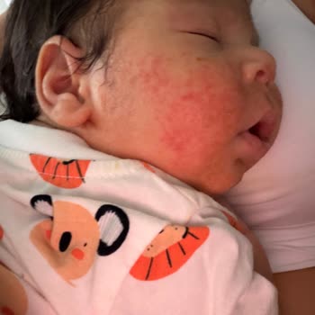 Bebekte Şiddetli Cilt Tahrişi: Mustela Yenidoğan Şampuanı