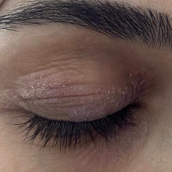 Bioderma Atoderm Göz Kremi Yanma Ve Egzama Yaratırken, Trendyol İade Sürecini Reddetti