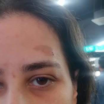 Alnındaki Yanıkla İlgili Mağaza Yetkilileriyle Yaşanan Sorun