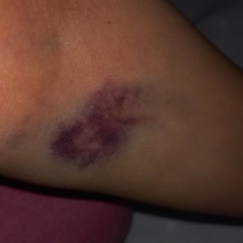 Kan Alımında Şiddetli Ağrı Ve Geniş Morarma Şikayeti