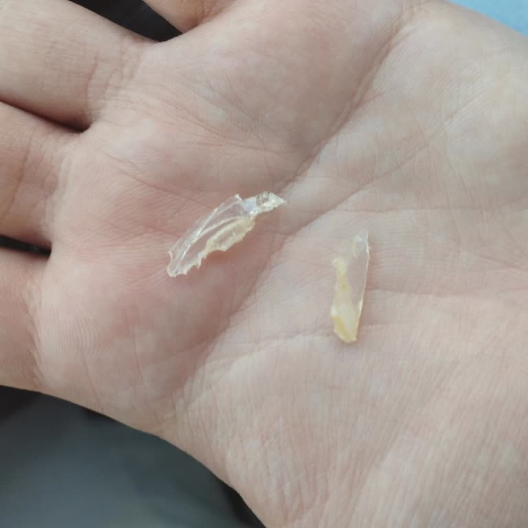 Burgerde Plastik Parça Bulunması: Sağlık Ve Hijyen Tehlikesi