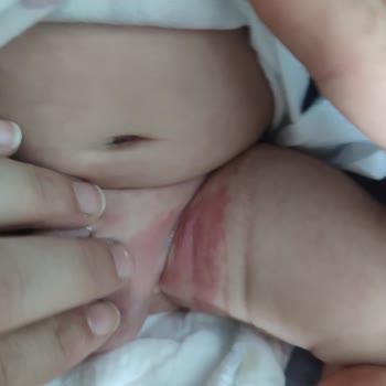 Molfix 1 Numaralı Bezlerde Aşırı Sızdırma Ve Şiddetli Pişik