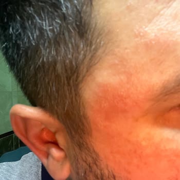 Bioderma C Vitamini Serumu Şiddetli Cilt Tahrişi Ve İade Talebi