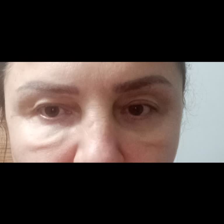 Op. Dr. Cihan Uçar Göz Altımdaki Şişlikler Kalıcı Hale Geldi
