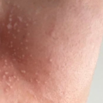 Bioderma Photoderm Stick Sonrası Şiddetli Alerjik Reaksiyon Ve İade Talebi