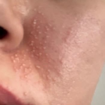 Bioderma Photoderm Stick Sonrası Şiddetli Alerjik Reaksiyon Ve İade Talebi
