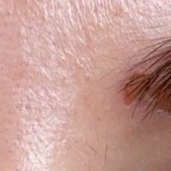 Bee Beauty Saç Boyası Kullanımında Şiddetli Kaş Yanması Ve Deri Soyulması