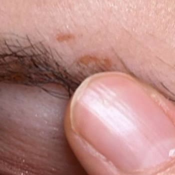 Bee Beauty Saç Boyası Kullanımında Şiddetli Kaş Yanması Ve Deri Soyulması