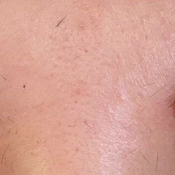 Bee Beauty Saç Boyası Kullanımında Şiddetli Kaş Yanması Ve Deri Soyulması