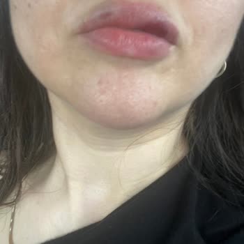Mare Clinic’te Dudak Vitamini Sonrası Morluk, Cevapsızlık Ve 5.000 TL Fazla Ücret