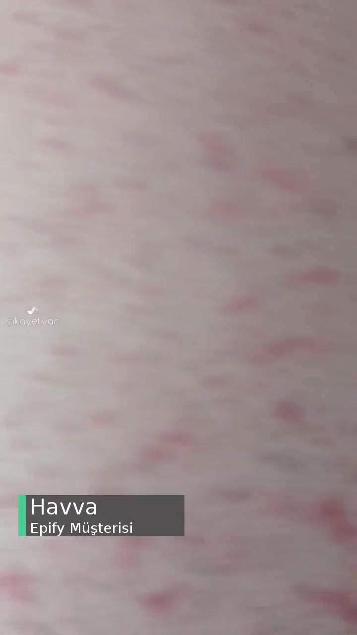 Epify Kullanımı Sonrası Ciddi Tahriş videonun kapak resmi