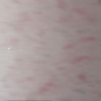 Epify Kullanımı Sonrası Ciddi Tahriş