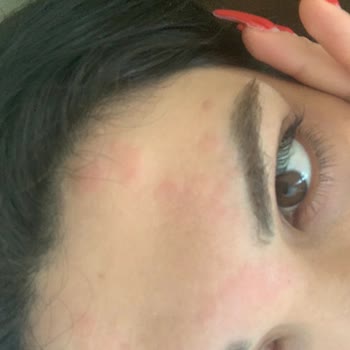 Nivea Panthenol Temizleme Suyunda Şiddetli Cilt Tahrişi Ve Egzama
