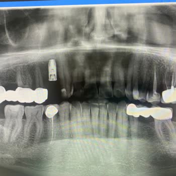 Dentius Klinik Hatalı Ve Eksik Tedaviler