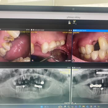 Dentius Klinik Hatalı Ve Eksik Tedaviler