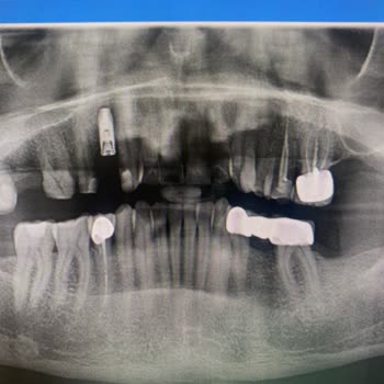 Dentius Klinik Hatalı Ve Eksik Tedaviler